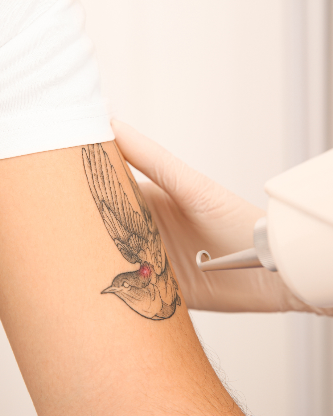 Remoção de Tatuagens